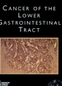 Cancer of the Lower Gastrointestinal Tract