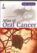 Color Atlas of Oral Cancer