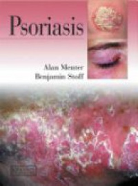 Menter A. - Psoriasis