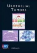 Urothelial Tumors